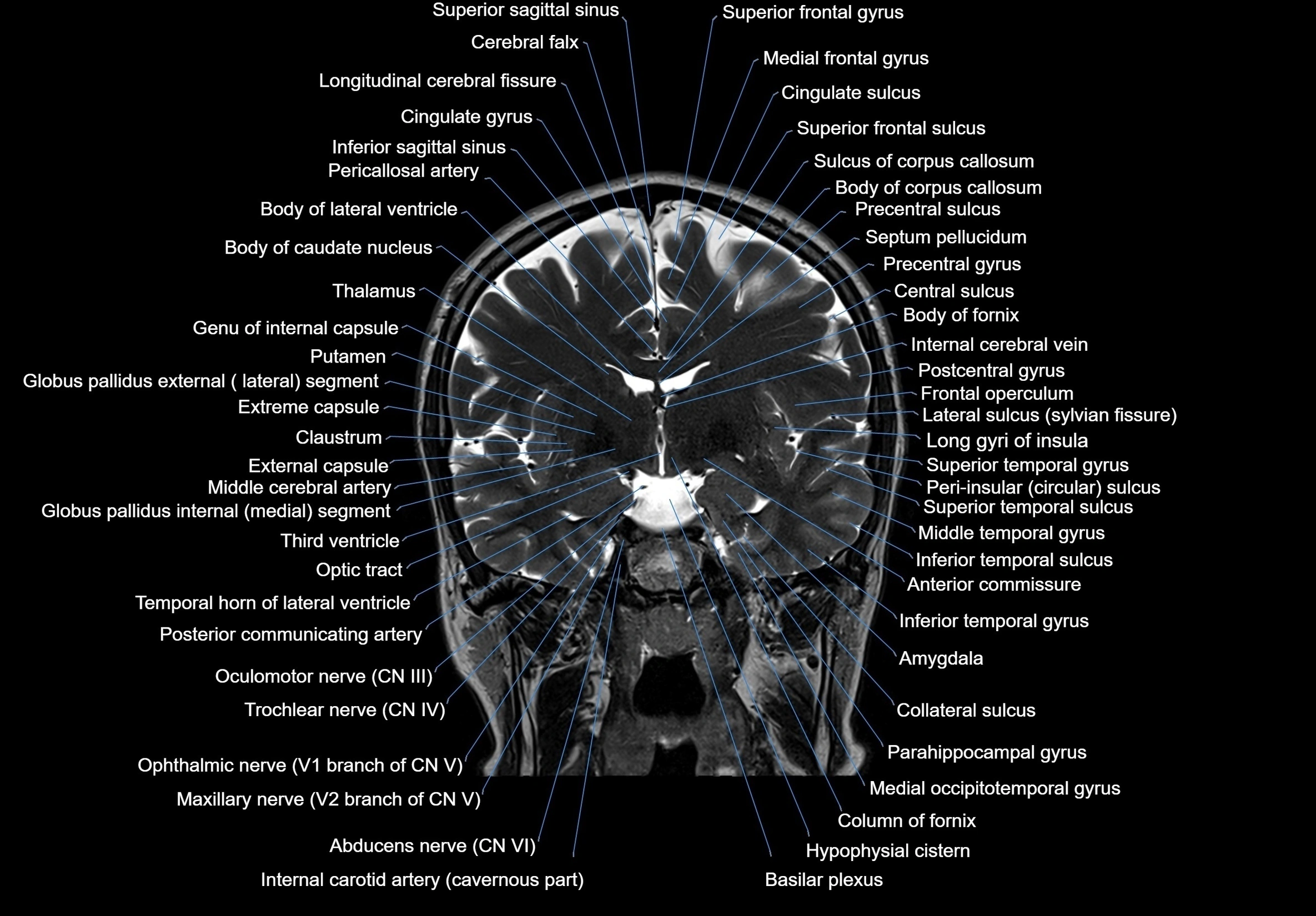 MRI Brain coronal cross sectional labelled anatomy 3T image  -img-00001-00035.webp